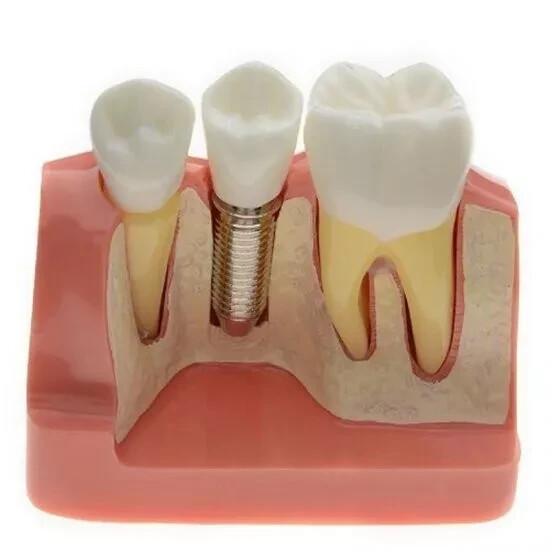 2Pc Dental Oral Analysis Crown Bridge Demonstration Tooth 4 Times Model Typodont