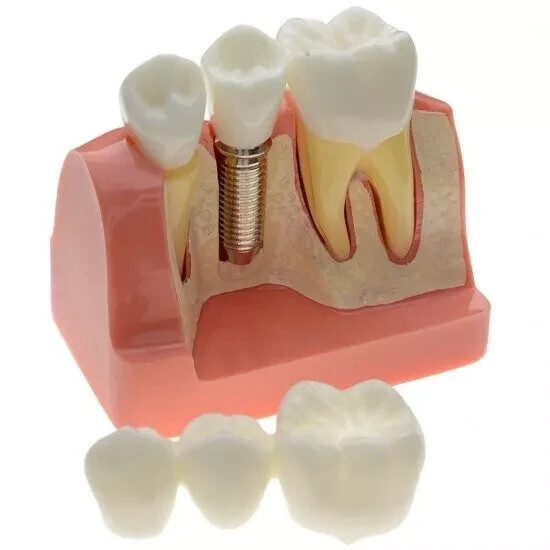 2Pc Dental Oral Analysis Crown Bridge Demonstration Tooth 4 Times Model Typodont