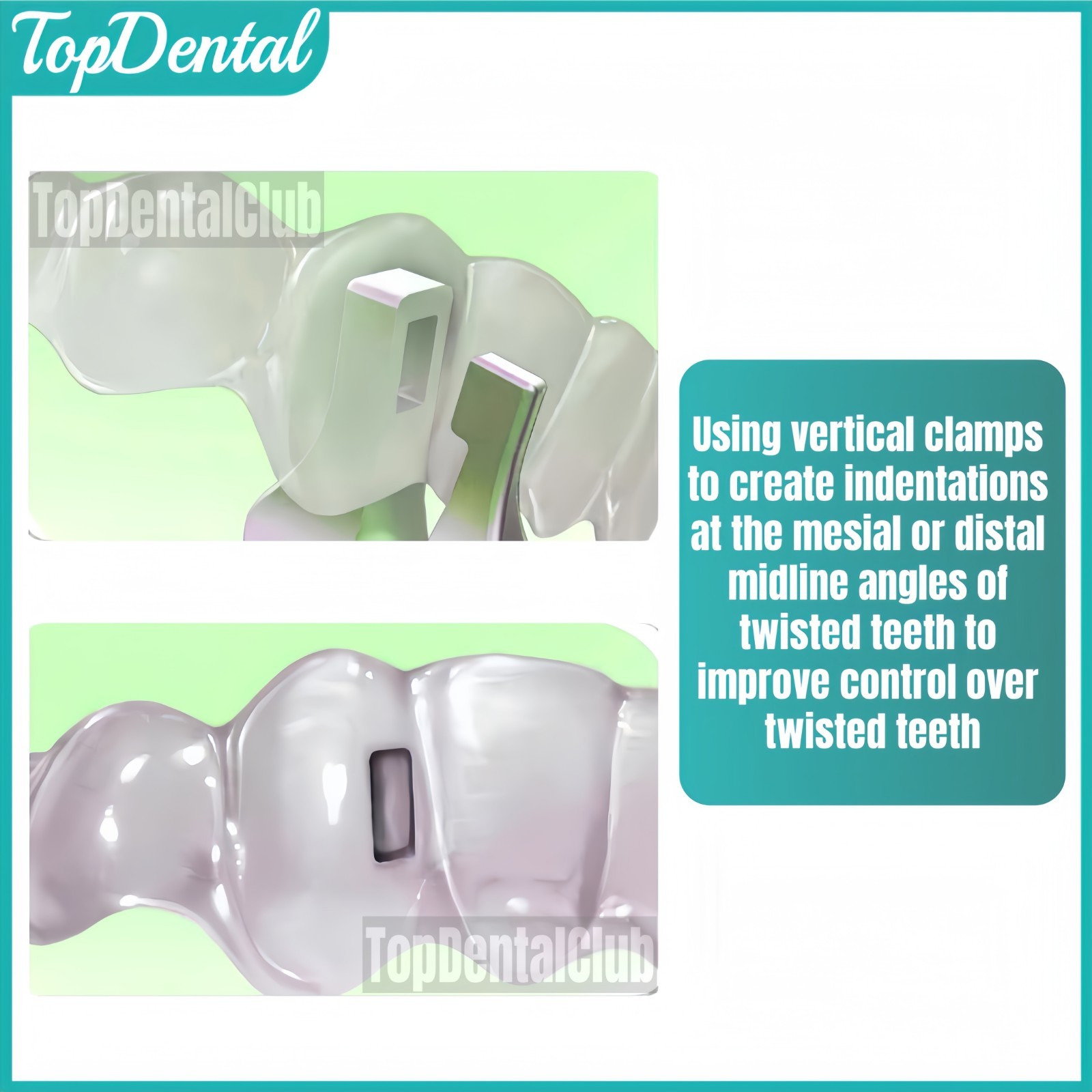 Dental Vertical Thermal Plier Clear Aligner Brace Invisible Retainer Ortho Plier
