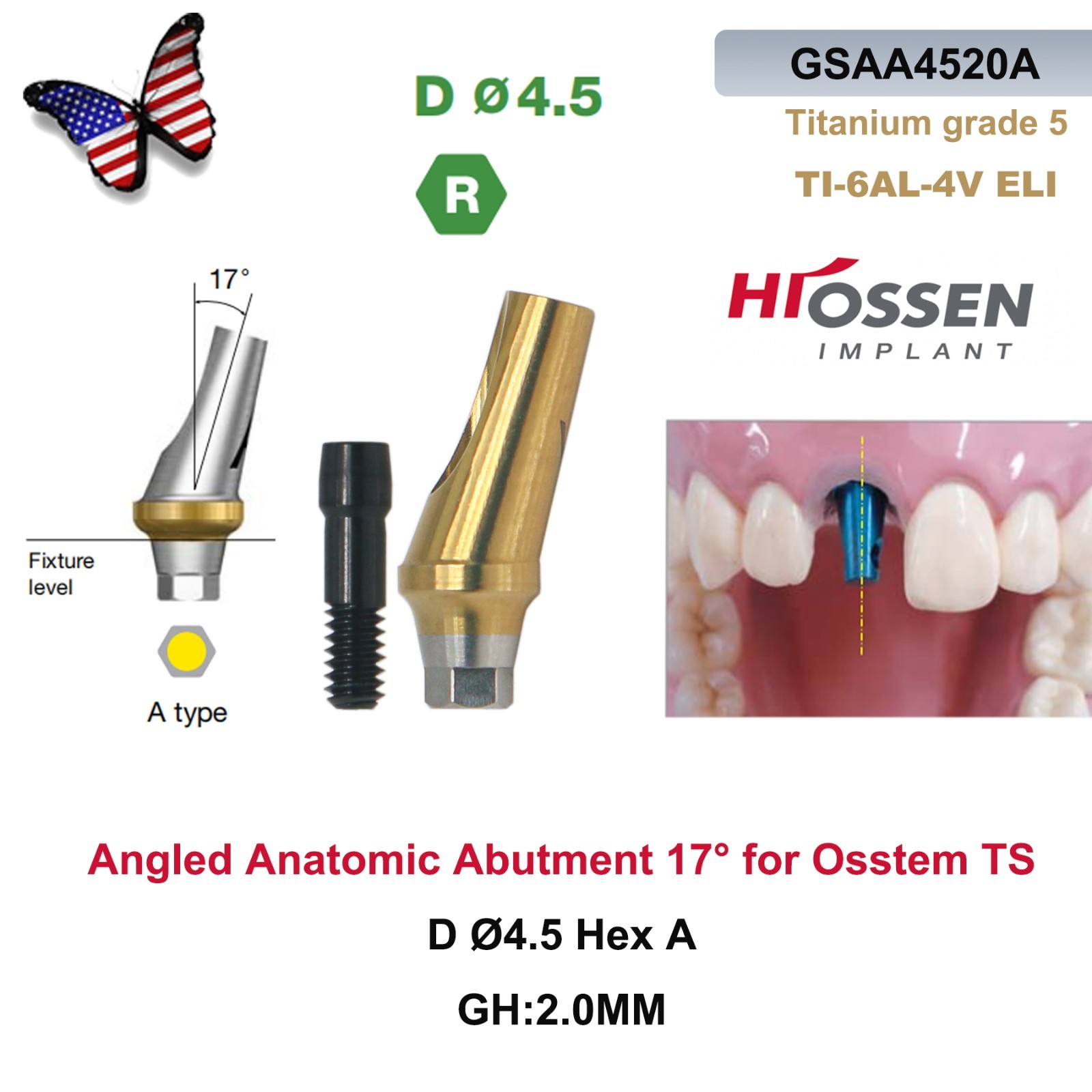US 17° Dental Angled Anatomic Abutment Hex Compatible with Hiossen ET/Osstem TS