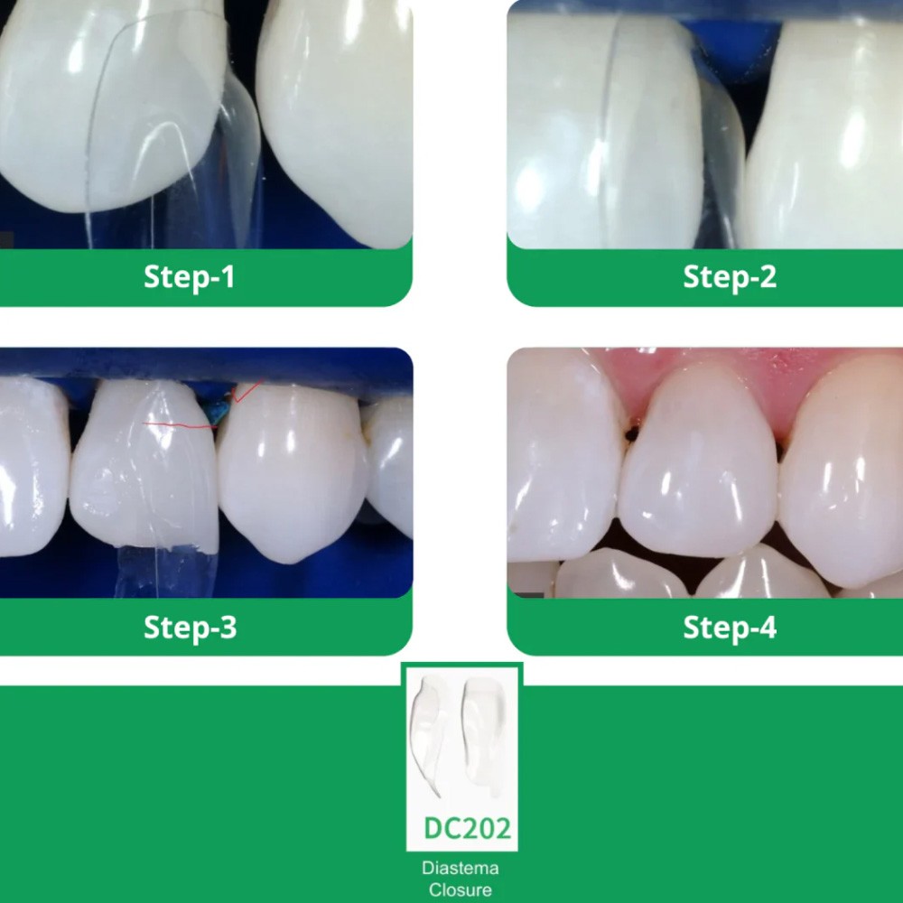 Bioclear Starter Matrix System mini Anterior Kit