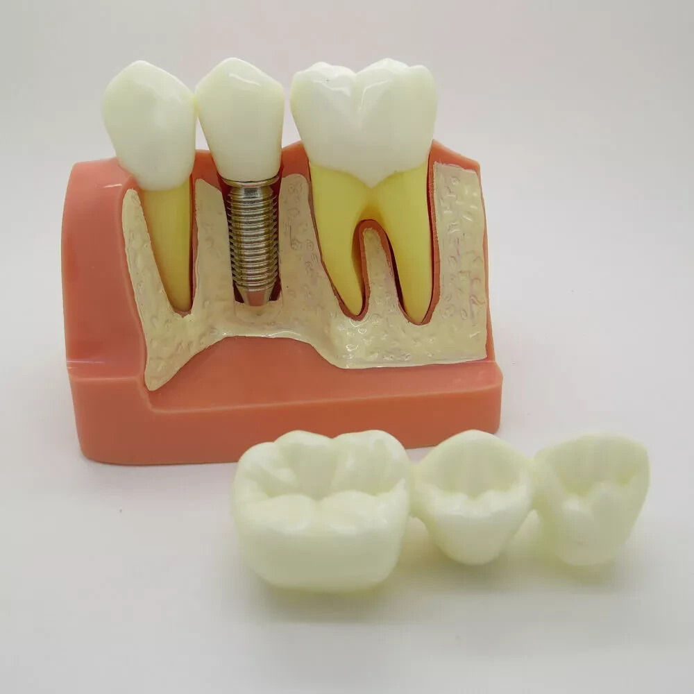 2Pc Dental Oral Analysis Crown Bridge Demonstration Tooth 4 Times Model Typodont