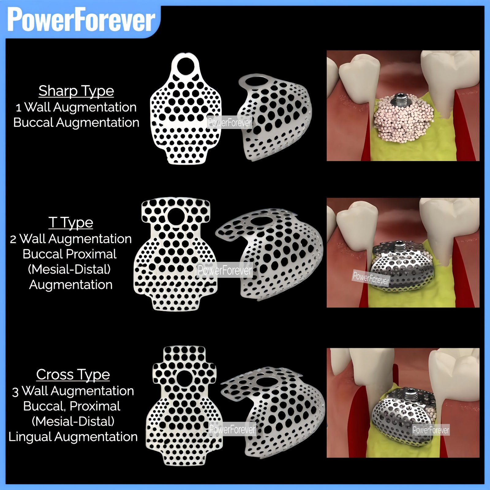 Dental GBR 3D Titanium Mesh Bone Incremental Membrane Implant Bone Formation