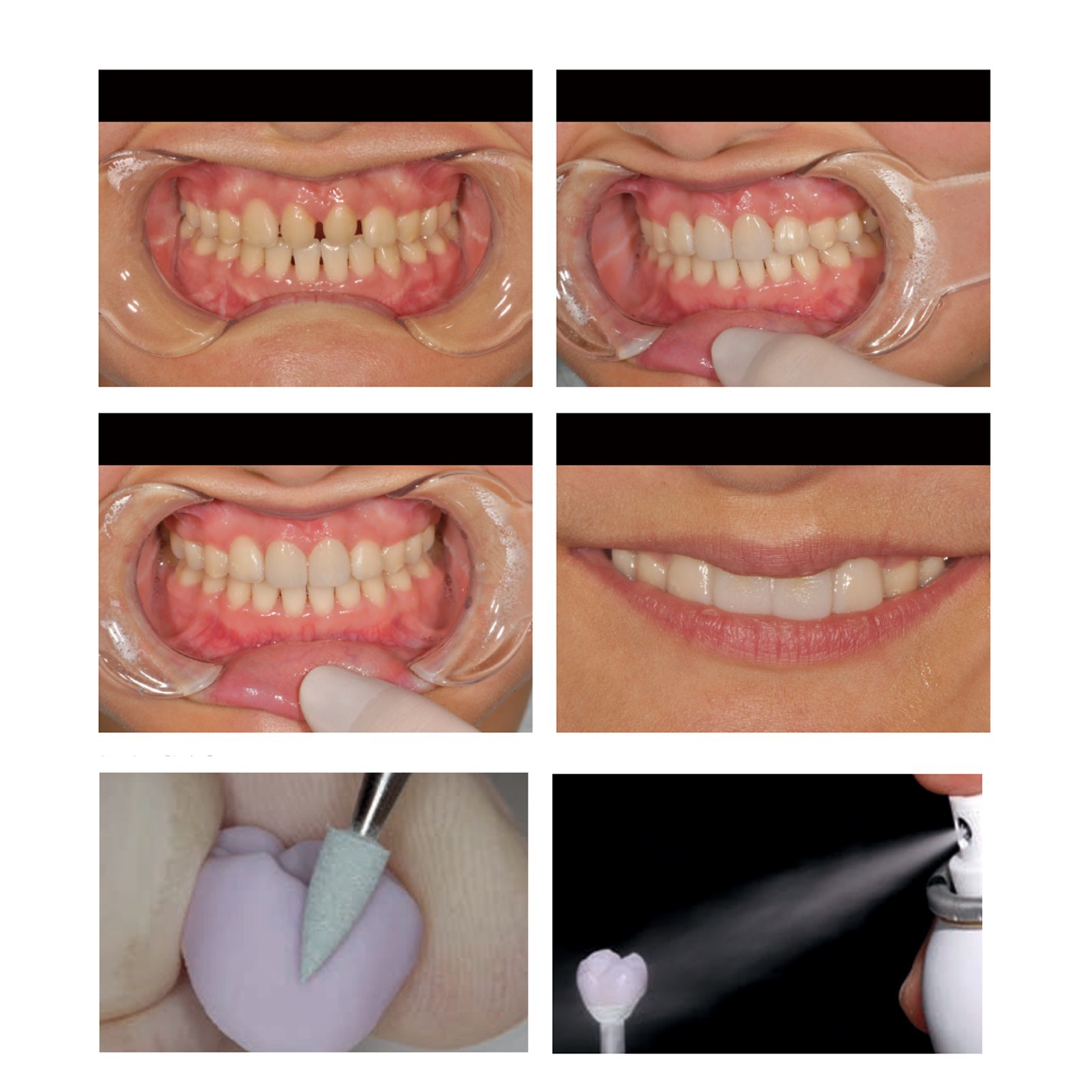 A16 Abutment Blocks Dental Emax CEREC CAD/CAM Milling Lithium Disilicate Blocks