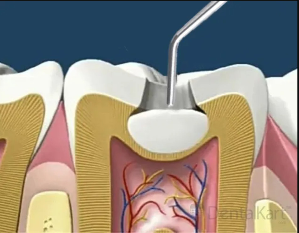 2 x META Dental JET FLOW BULK Superior Bulk fill Flowable Restorative Composite