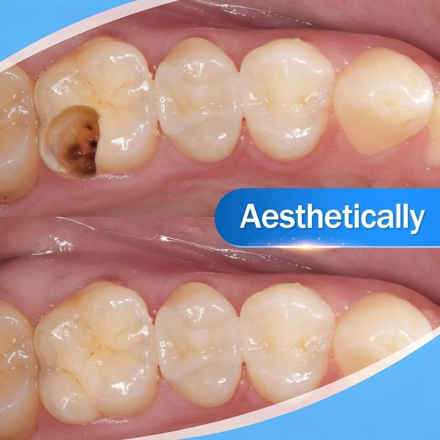 Dental Composite Resin Light Cure White Veneer Hybrid Aesthetic teeth resin 2.5g