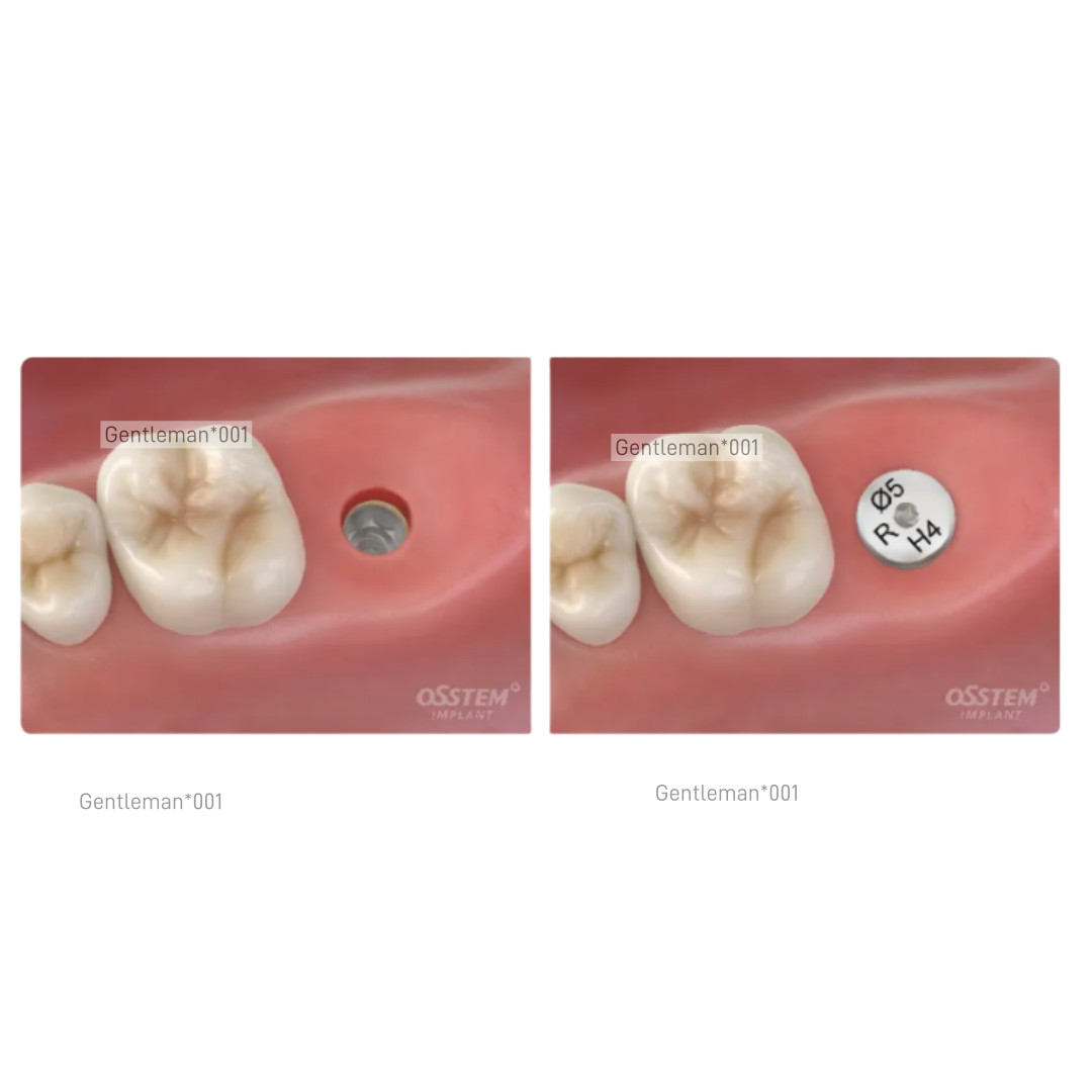 Dental Implan Healing Abutment Caps Cover Screw Mini Regular Platform Titanium