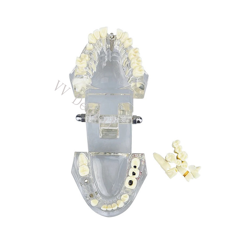 Dental Disease Model Teeth Teach Study Oral Teeth Bridge Restoration Pathology