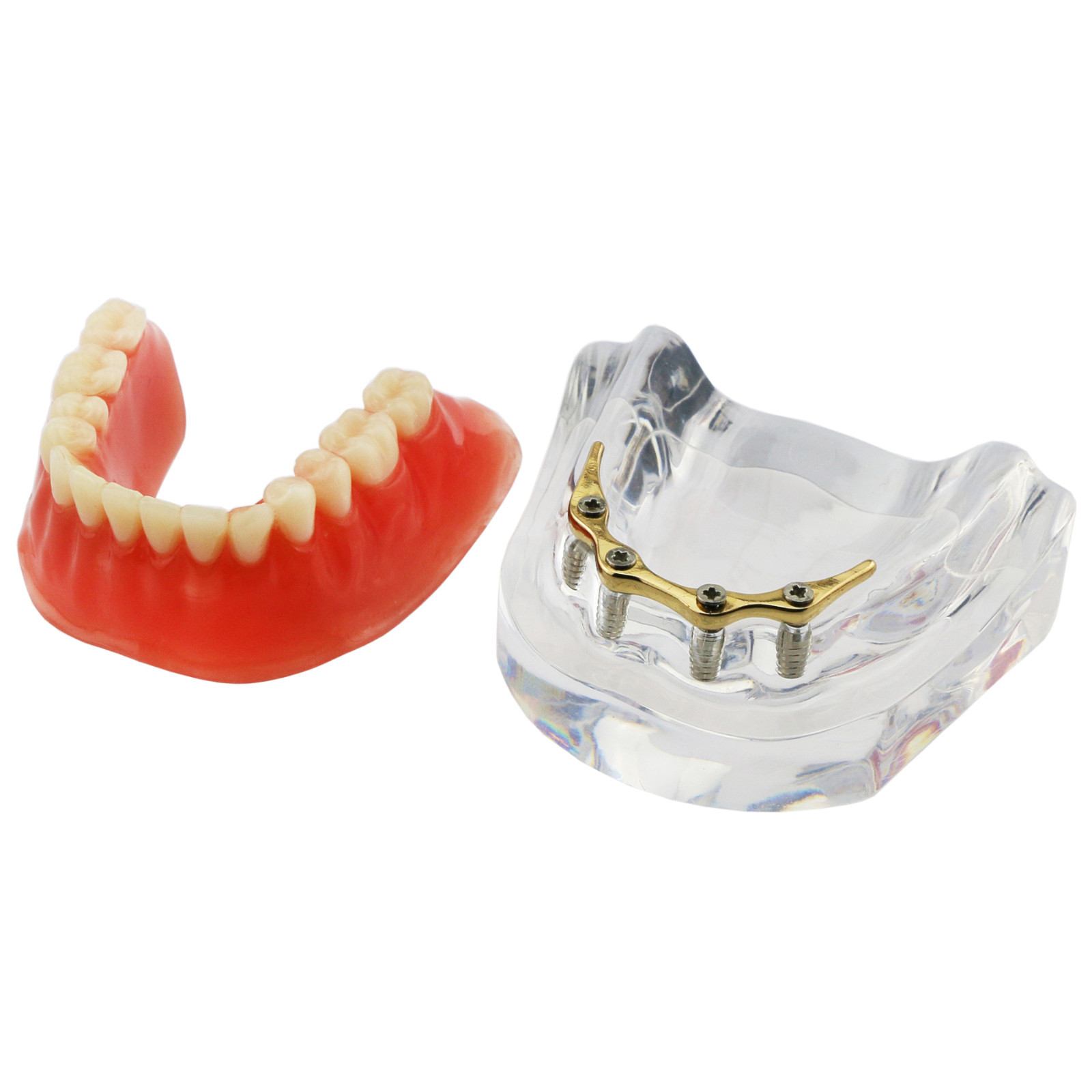 Dental Teeth Implant Model Inferior Overdenture 4 Implants Denture Demo Training