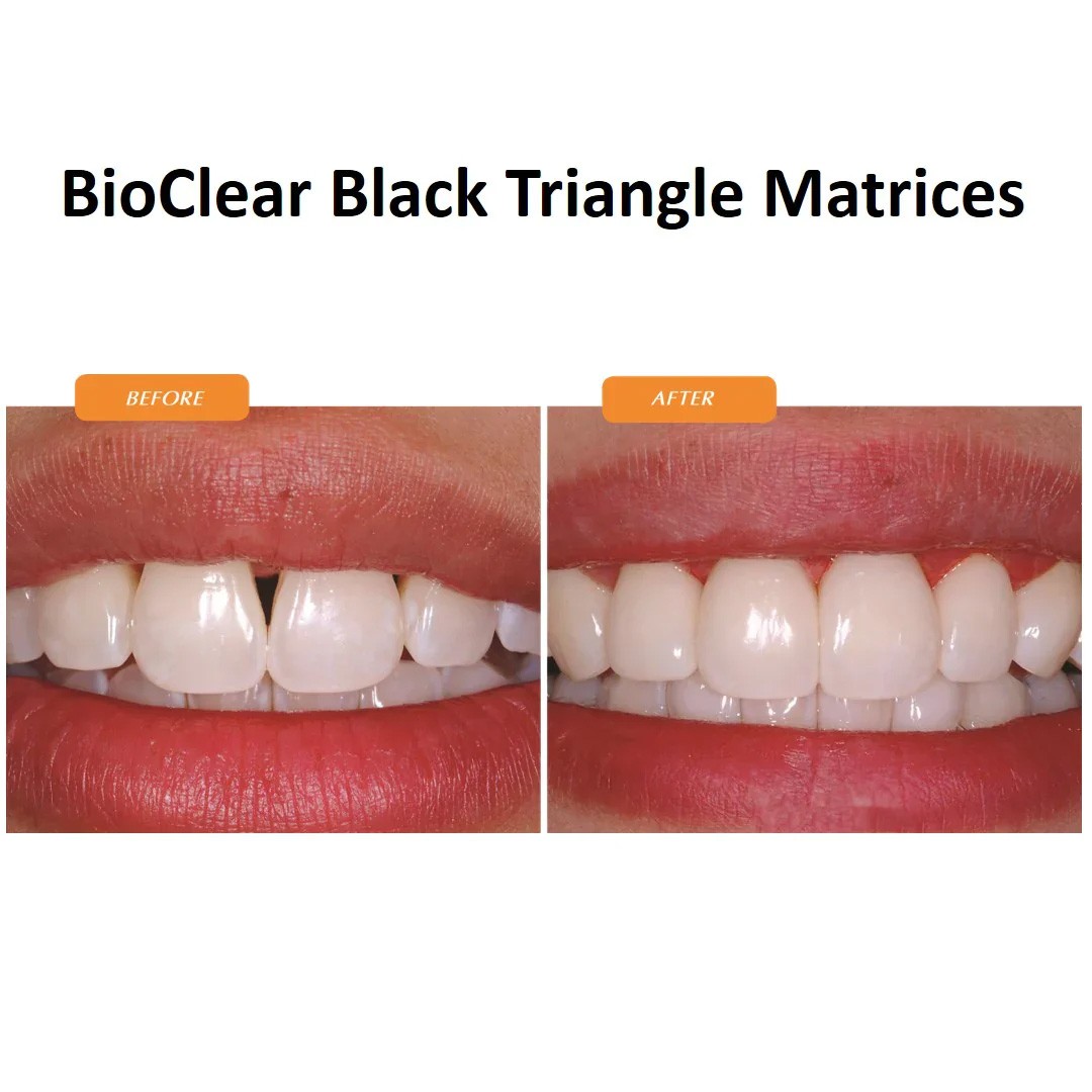 Bioclear Black Triangle Anterior Matrices Small – Yellow (1.5mm)