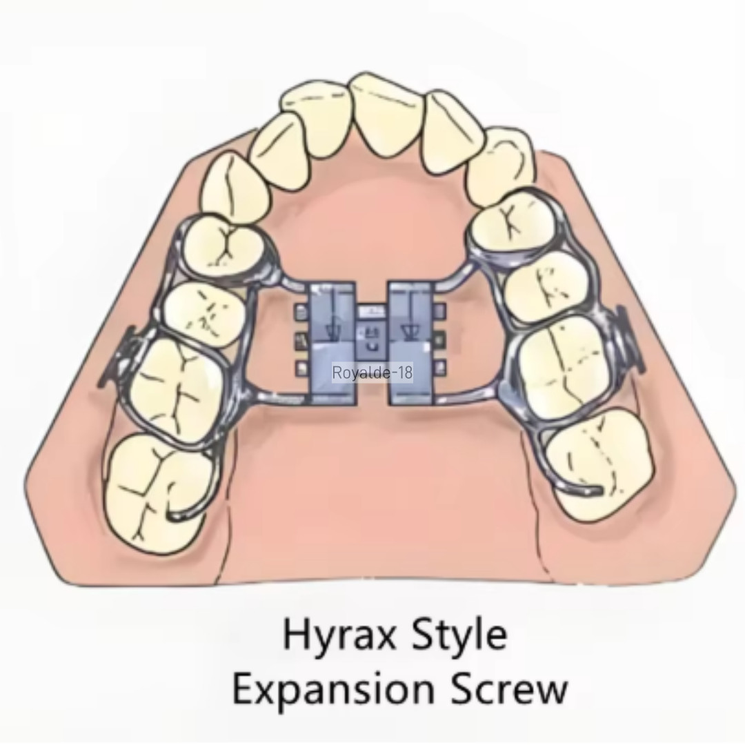 MSE Dental Palatal Expander Screw Rod Orthopaedic Mid Facial Parallel Expansion