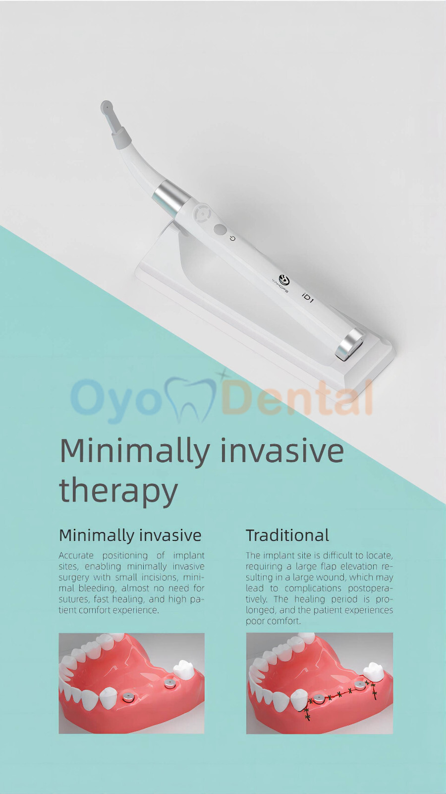 Dental Implant Detector Implant Abutment Locator Tool Smart 360° Rotating Sensor