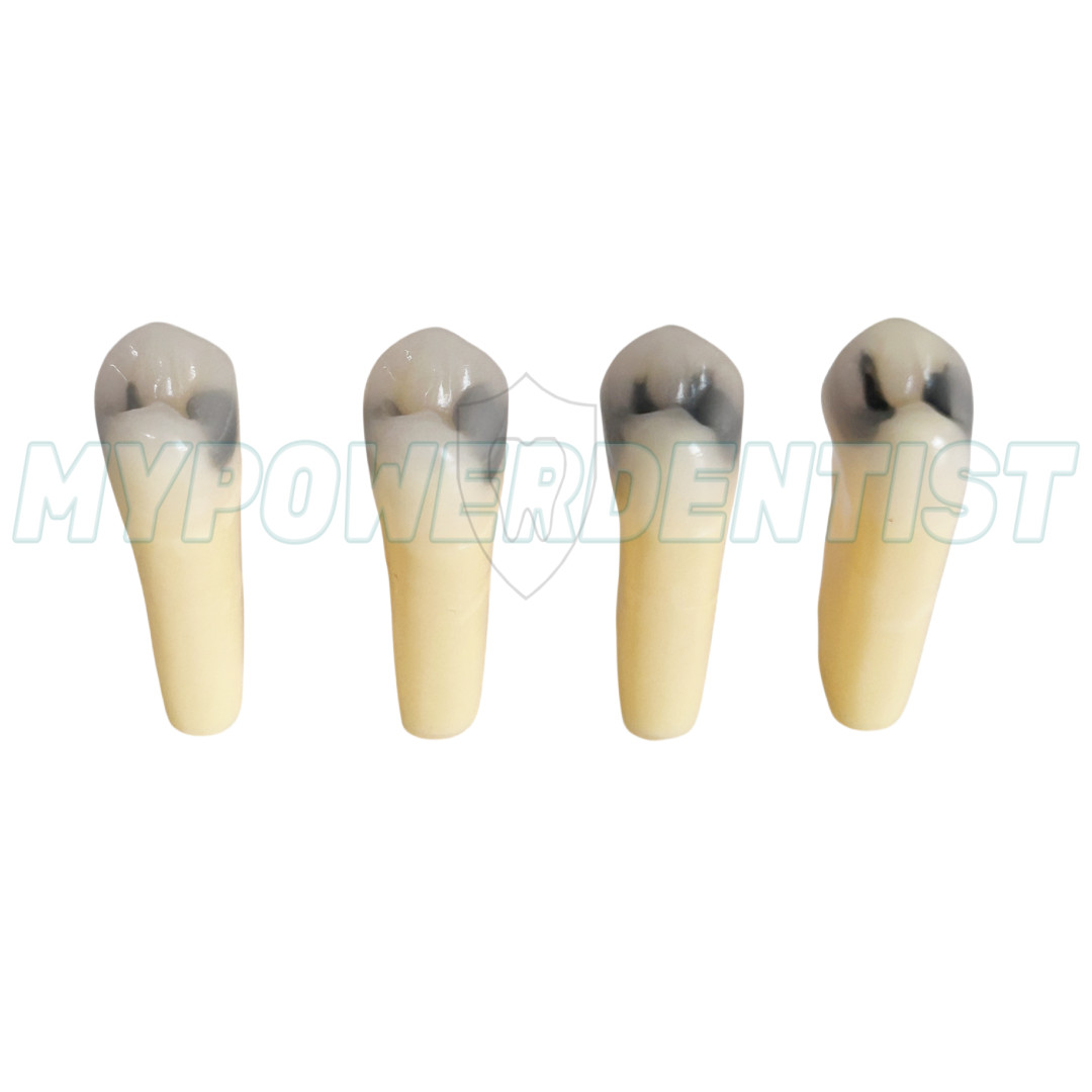 25# Dental Cavity Teeth Model Tooth Teaching Caries ModelCompatible Frasaco AG-3