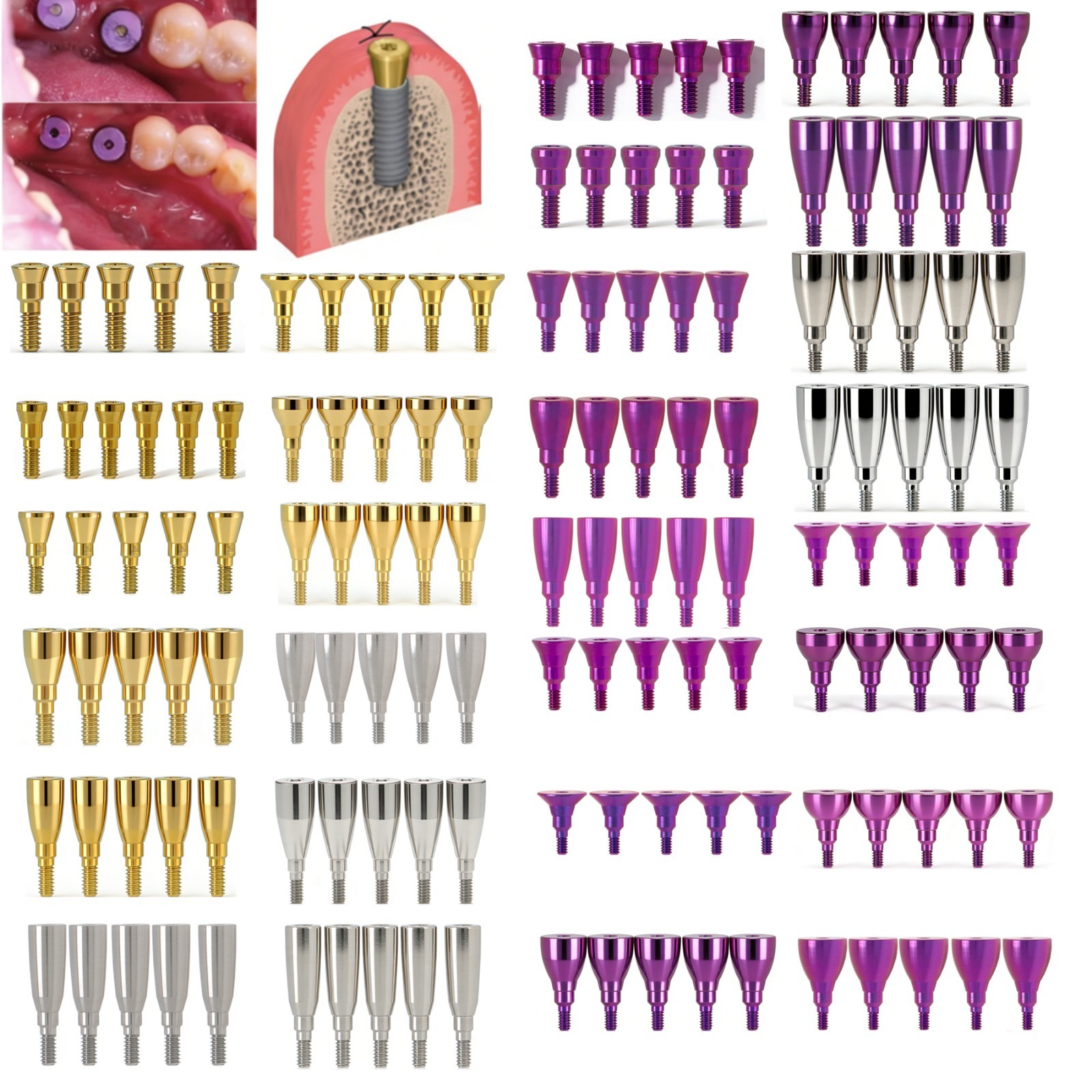 Multiple Implant Healing Abutment & Closure Cover Screw Hiossen Nobel Straumann