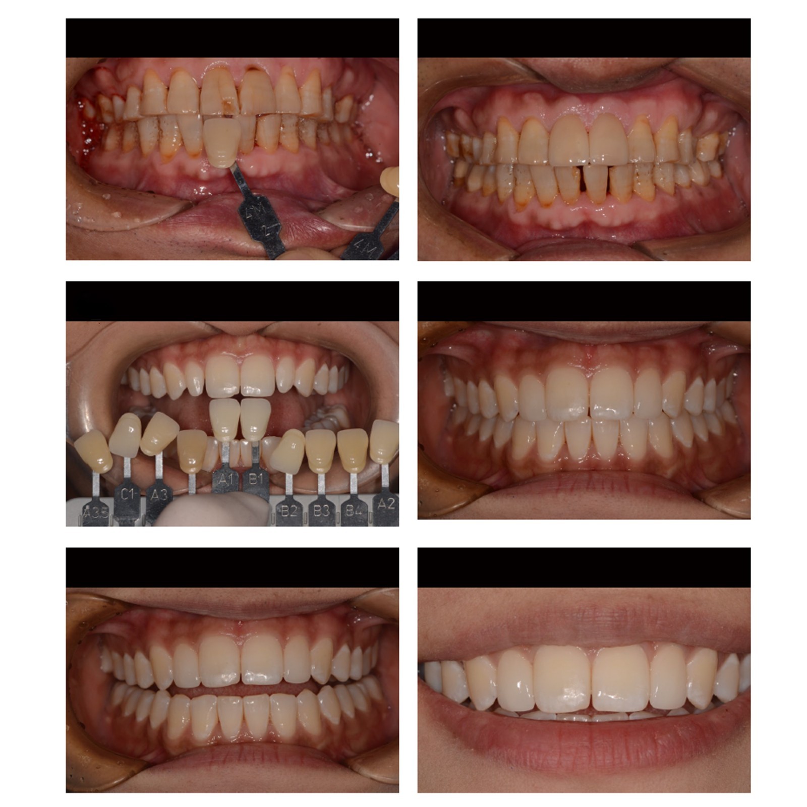 A16 Abutment Blocks Dental Emax CEREC CAD/CAM Milling Lithium Disilicate Blocks