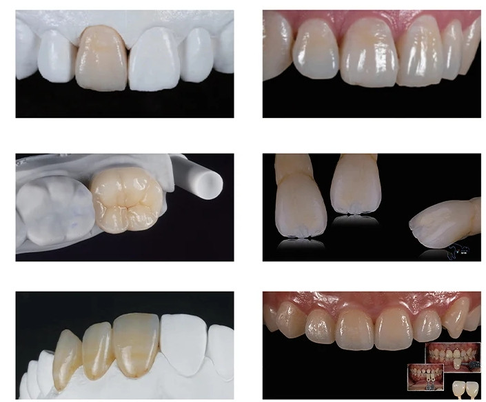 US C14 Lithium Disilicate Dental Emax Glass Ceramic CAD/CAM Blocks HT LT 5/Box