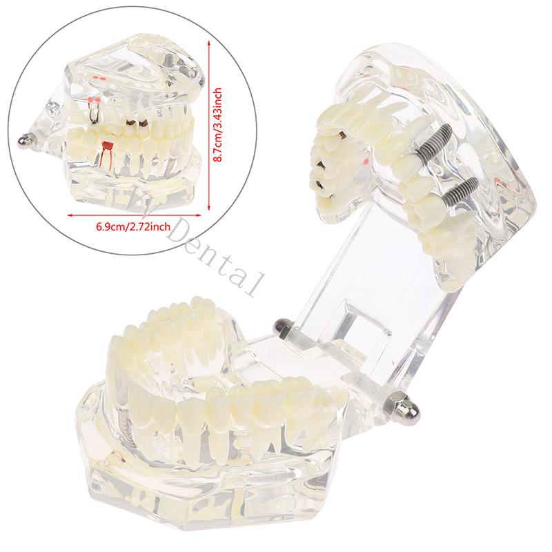 Dental Disease Model Teeth Teach Study Oral Teeth Bridge Restoration Pathology