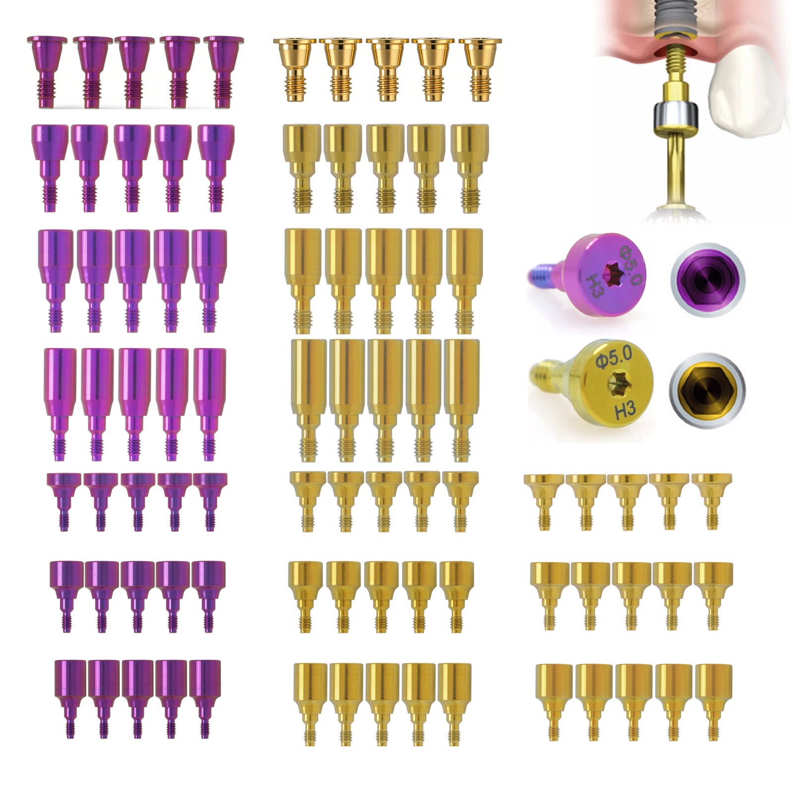 US Implant Nobel Biocare Hex Healing/Impression Coping/ScanBody/Locator Abutment