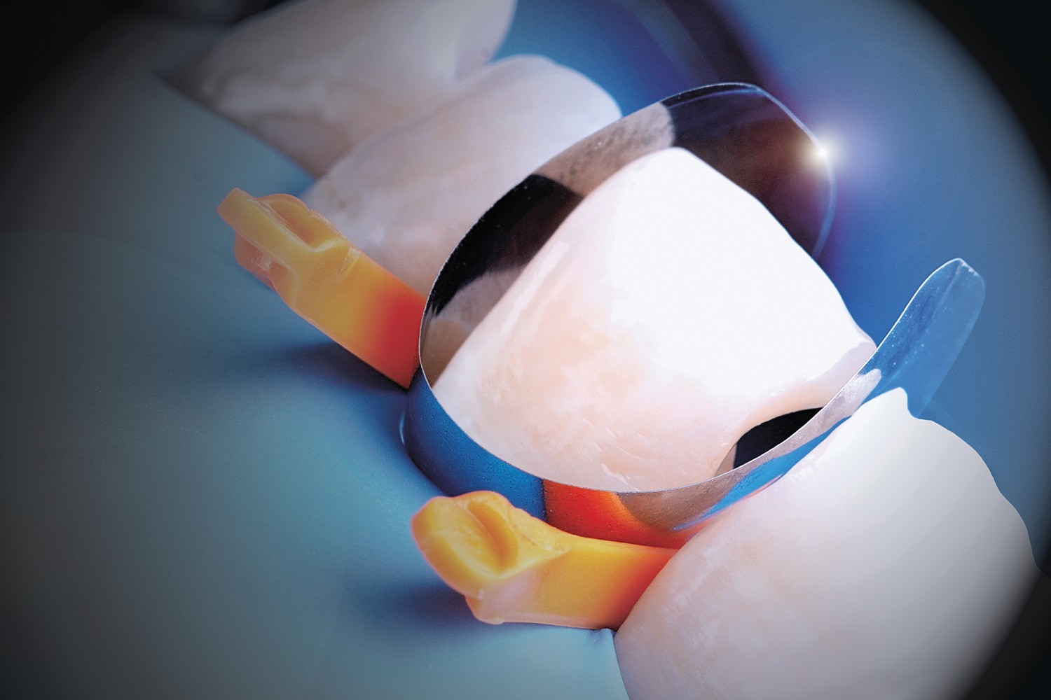 Polydentia Unica Anterior Dental Matrix System Intro Kit II Free Ship