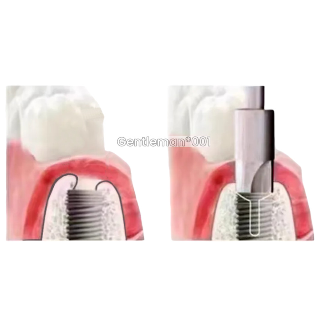 Dental Countersink Drill Smooth Ridge Trimmer Drills Abutment Remove