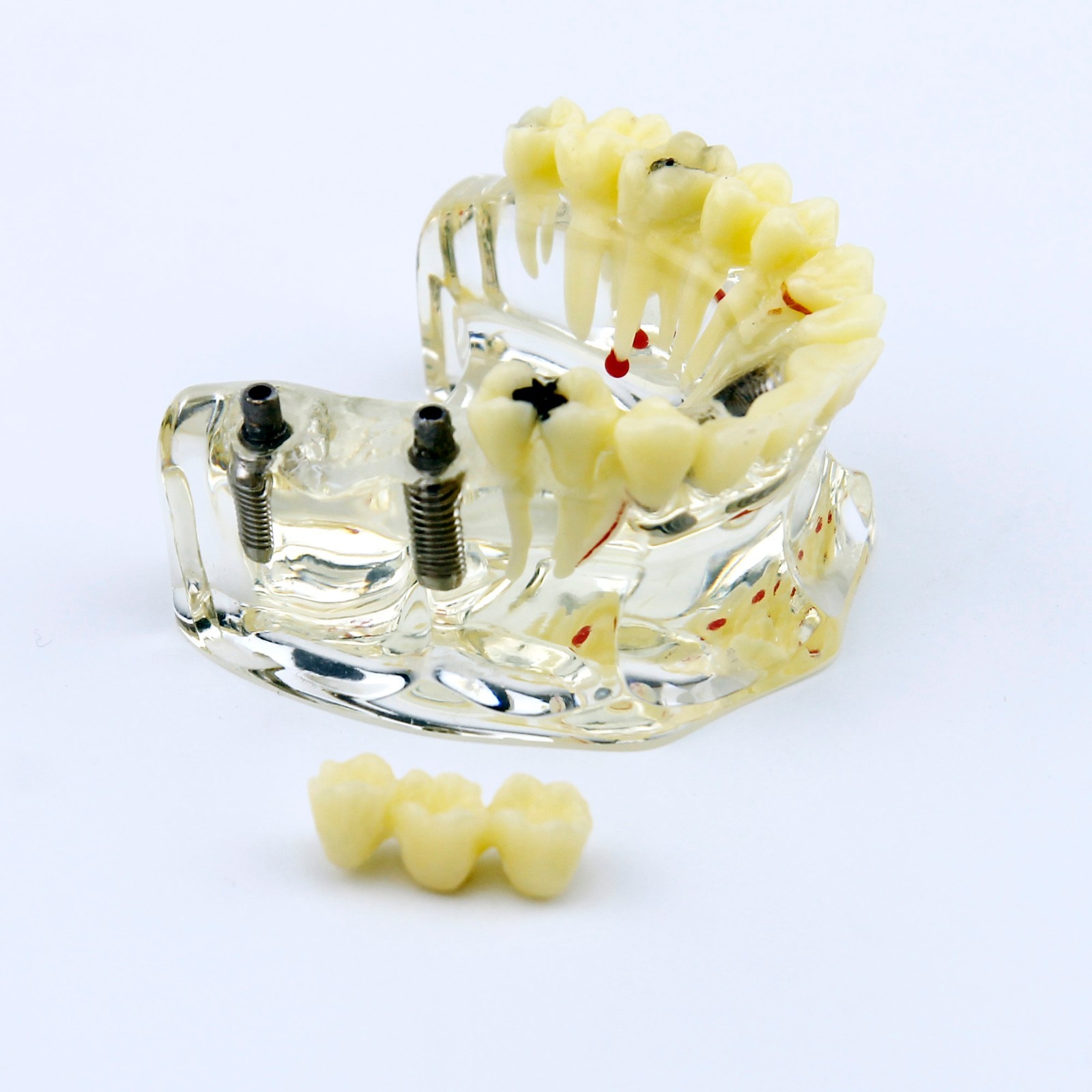 Dental Upper Jaw Implant Model with Bridge and Caries -I 2006
