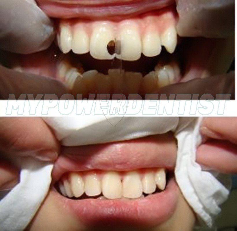 Dental Cavity Teeth Model Tooth Teaching Caries 25# Compatible Frasaco AG-3