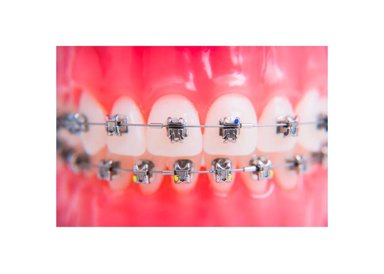 Ortho Shop Pre-Stopped Cu-NiTi Archwire, Universal Form, .018″, 20/Pk. Ideal