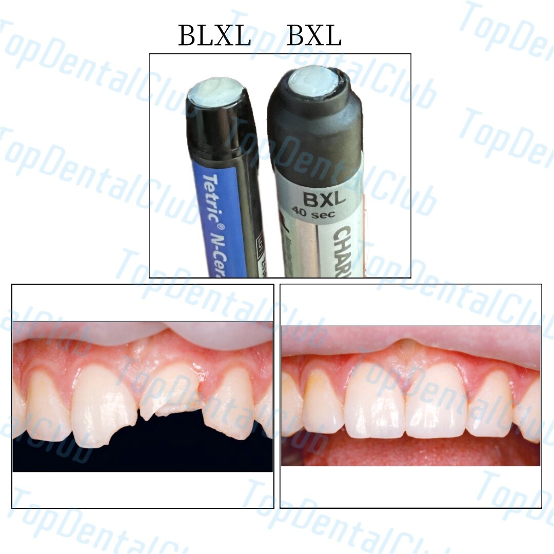 BXL/BLXL Dental Charisma Tetric N-Ceram Composite Resin Syringe Light Cure Tooth