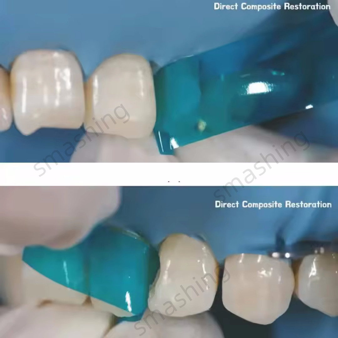 5Box Dental Blue View Matrix Contoured Anterior Matrices Mylar Anatomical Strip