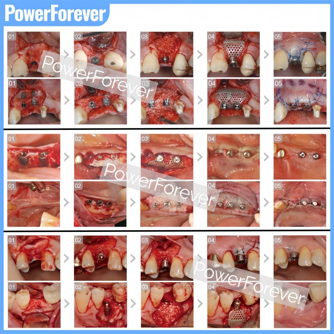 Dental GBR 3D Titanium Mesh Bone Incremental Membrane Implant Bone Formation