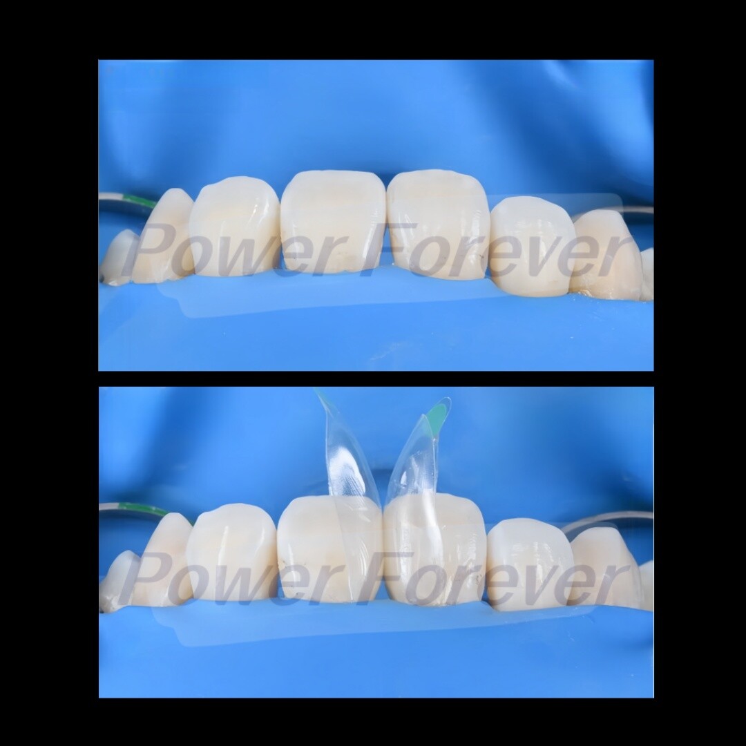 W2 Dental Anterior Distal Matrix Clear BT Bow Maxillary Matrices Contoured