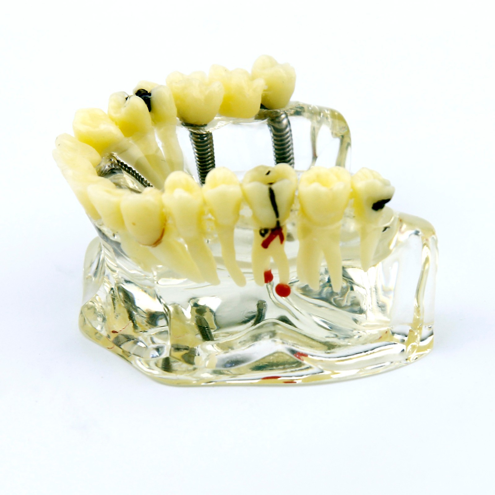 Dental Upper Jaw Implant Model with Bridge and Caries -I 2006