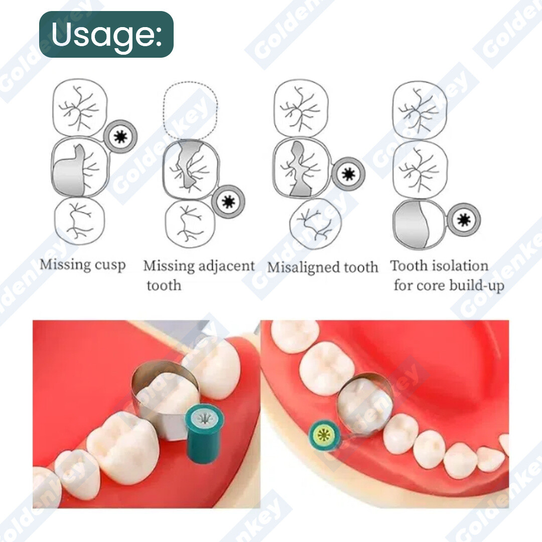 Dental Matrix Bands Reel Matrices M6 Metal Double-Side Anatomically Shaped Soft