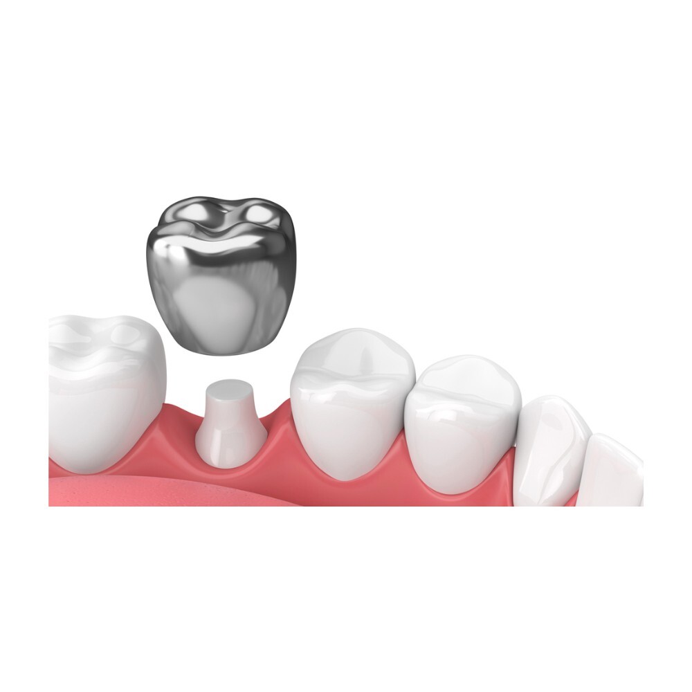 J&J Ortho Stainless Steel Molar Crown Kit for Kids and Adults