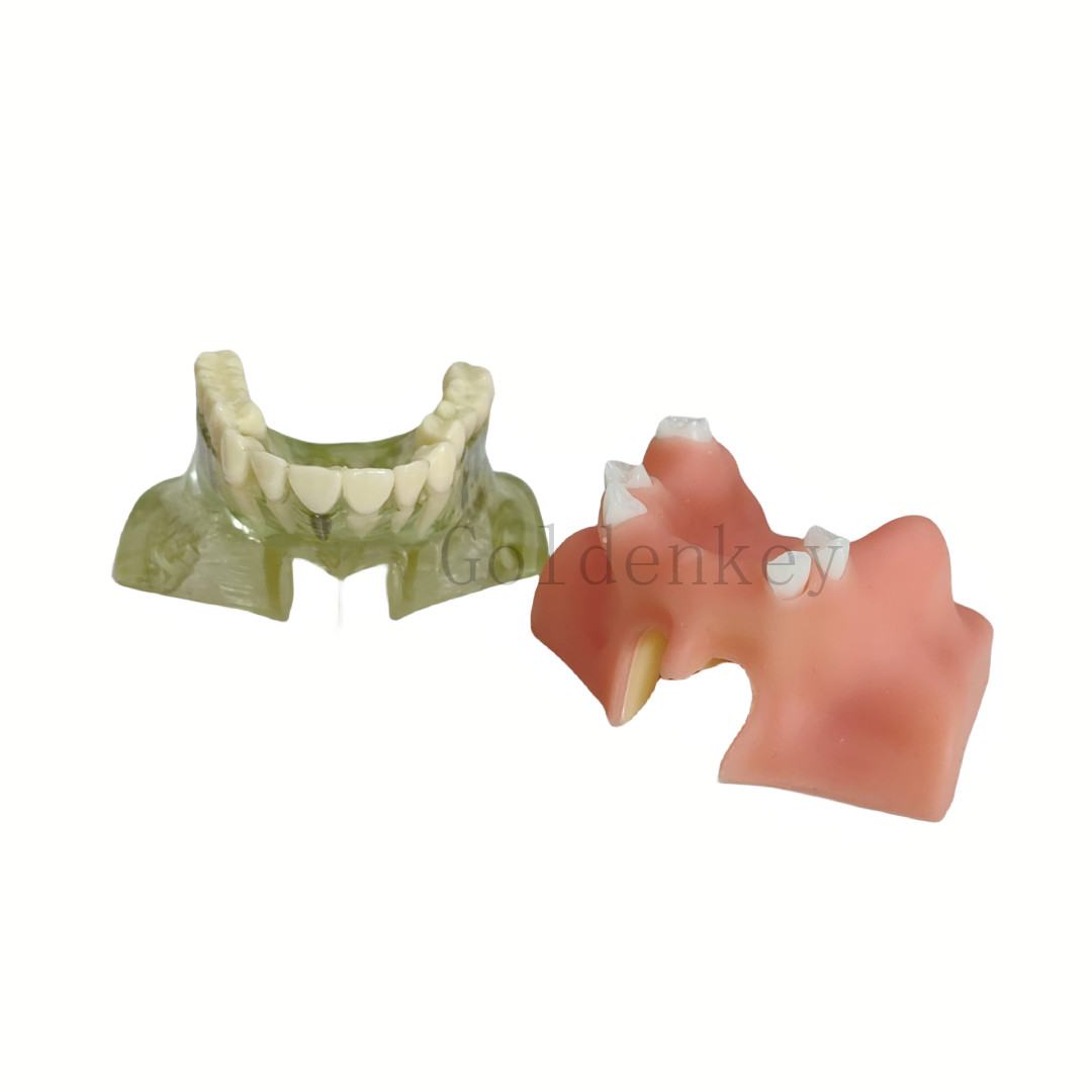Dentist Student Tool Dental Model Upper Jaw With Crown Bridge