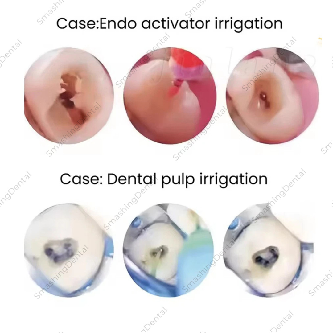 Dental Sonic Irrigator Tips Endo Sonic Activator Tips For Root Canal Dental Tool