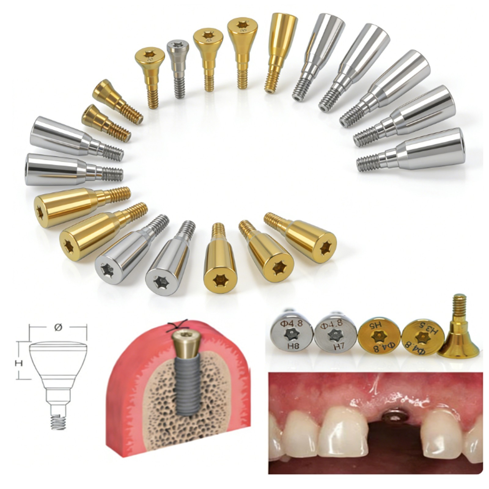 US Dental Healing Cap Abutment RC NC Cover Screw Titanium Fit Straumann ITI BLT