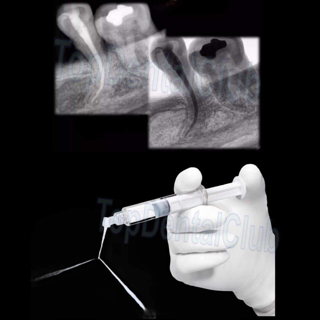 2Sizes Dental Root Canal Therapy PD IrriFlex Style Flexible Irrigator Tips Flush
