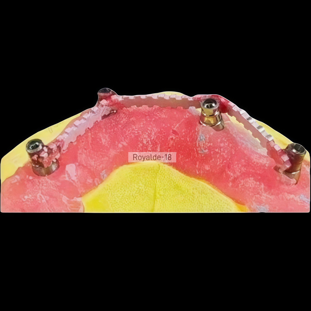 Dental Implan Connector Stainless Tianium Strengthener Wire Overdenture MU Wire