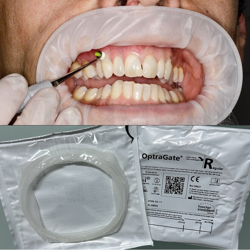 Ivoclar OptraGate Assortment Non Latex Optragate Lip & Cheek Retractor 10Pcs