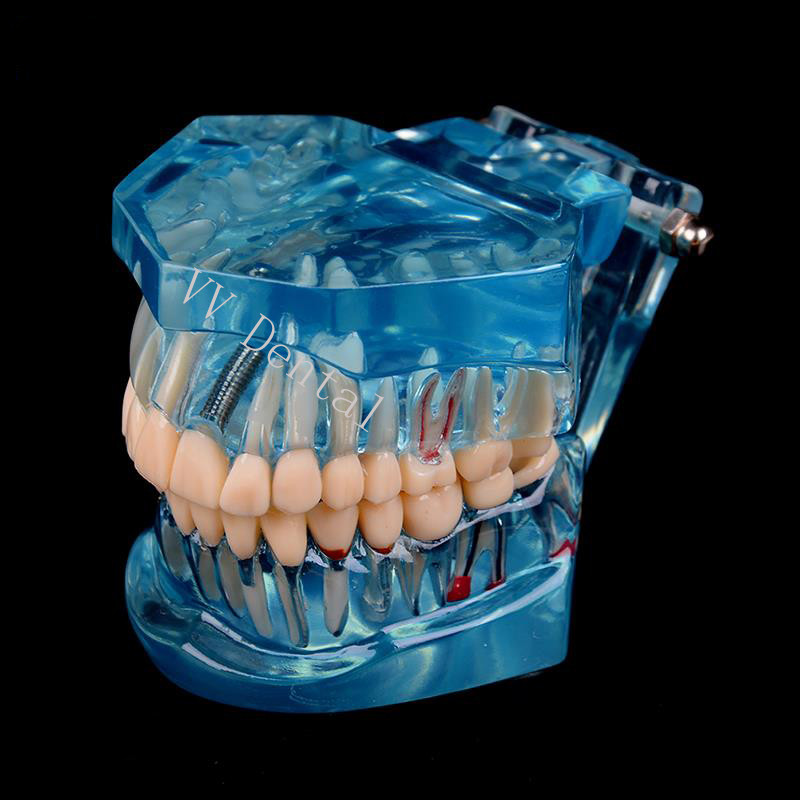 Dental Disease Model Teeth Teach Study Oral Teeth Bridge Restoration Pathology