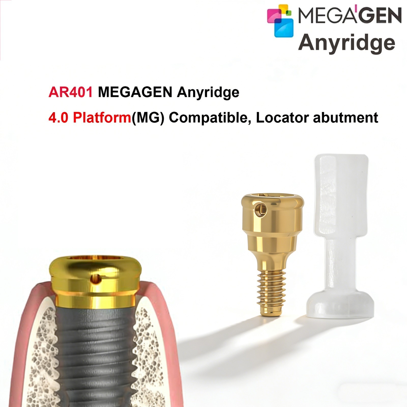 Zest Locator Overdenture Abutment Anchor For MEGAGEN AnyRidge AR Retention Caps