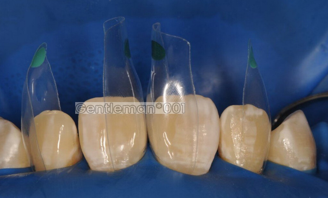 SIGNET Dental Widening Front Tranparent Clear Matrix BT Matrices Fits BioClear