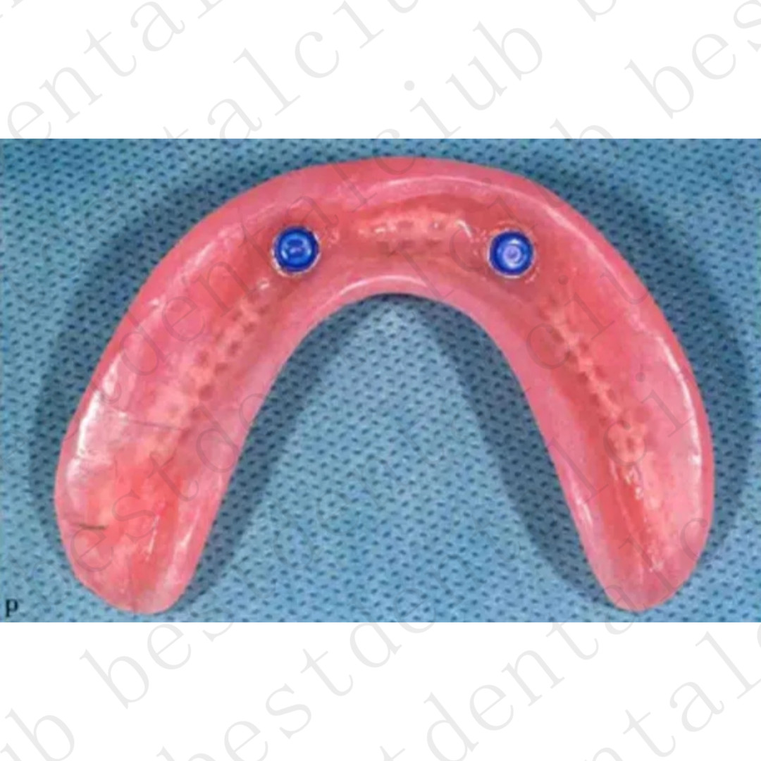 10Kits Dental Overdenture Locator Abutments Retention Caps Implant Inserts