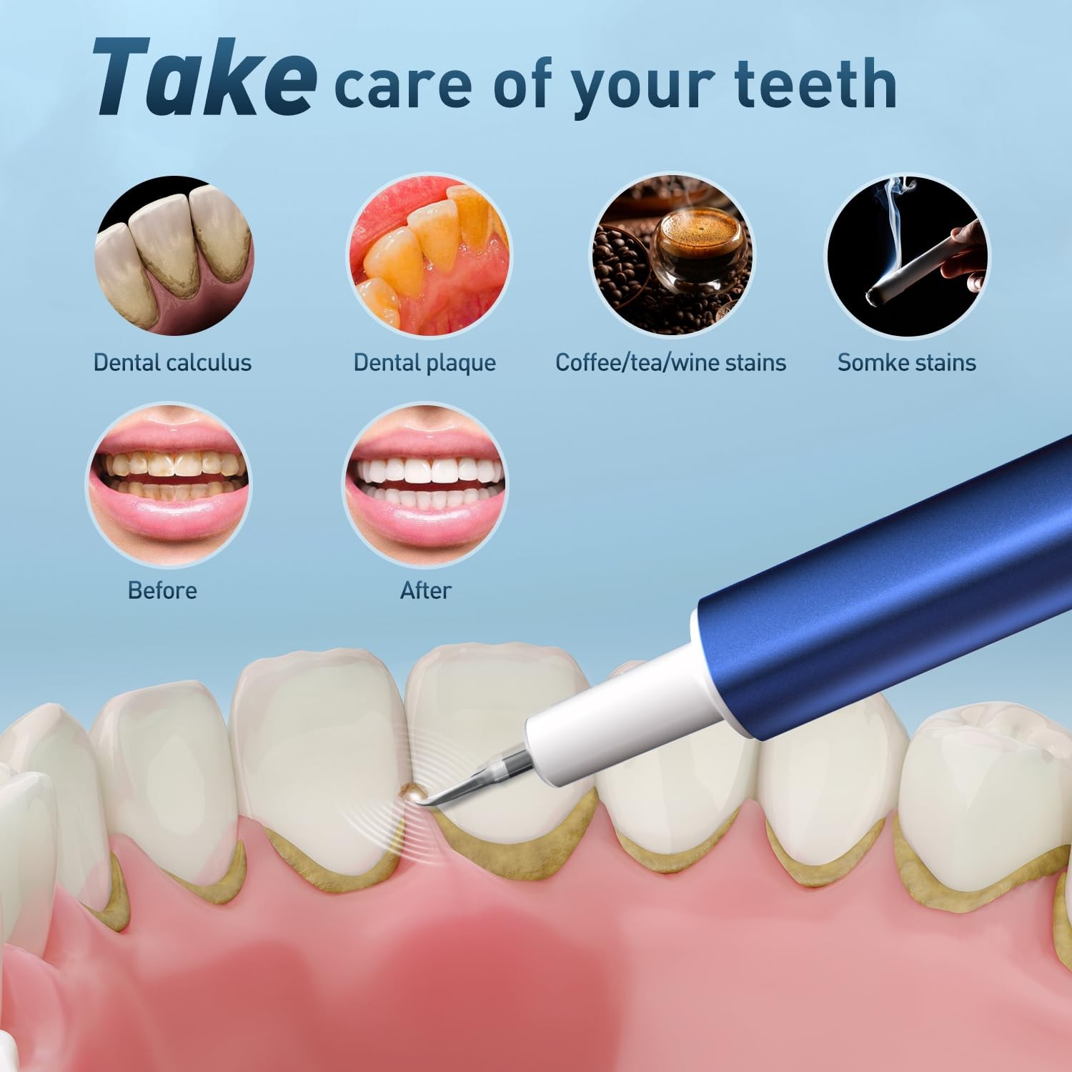 Plaque Remover for Teeth, Dental Calculus & Teeth Cleaning Kit, Blue
