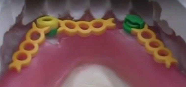 DSI Dental Lab Fixture OT Box Micro Castable Overdenture Ball Attachment Kit