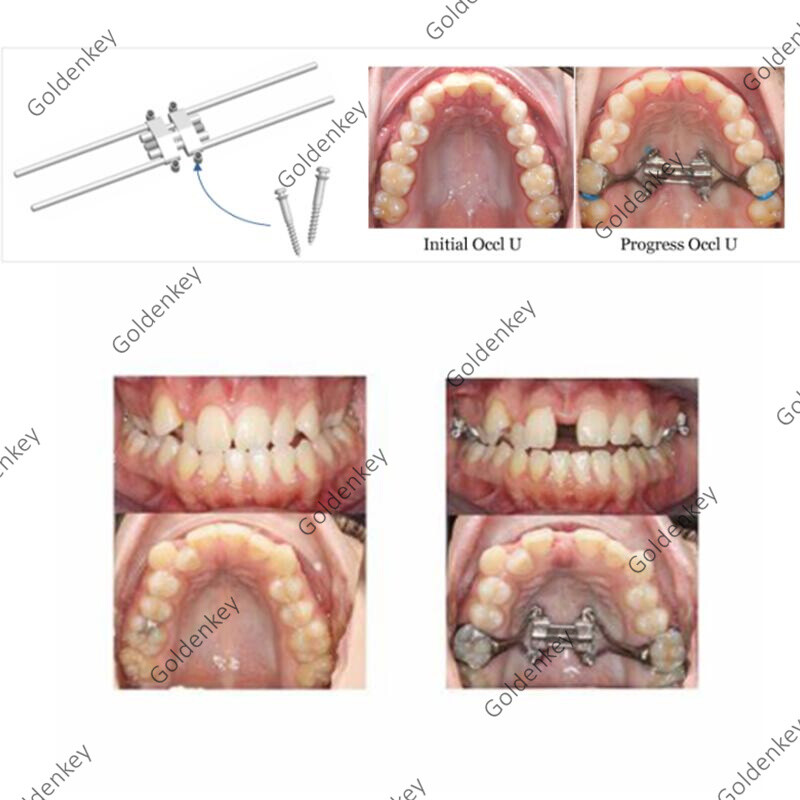 Dental MSE Maxillary Skeletal Expander Orthodontics Expansion Split Adult II BMK