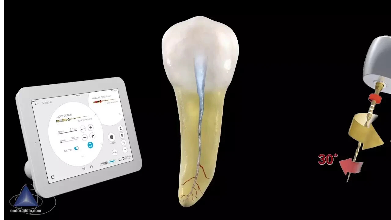 Waveone Gold Glider 25mm RECIPROCATING Glide Path File Dentsply-15 files (5 pks)