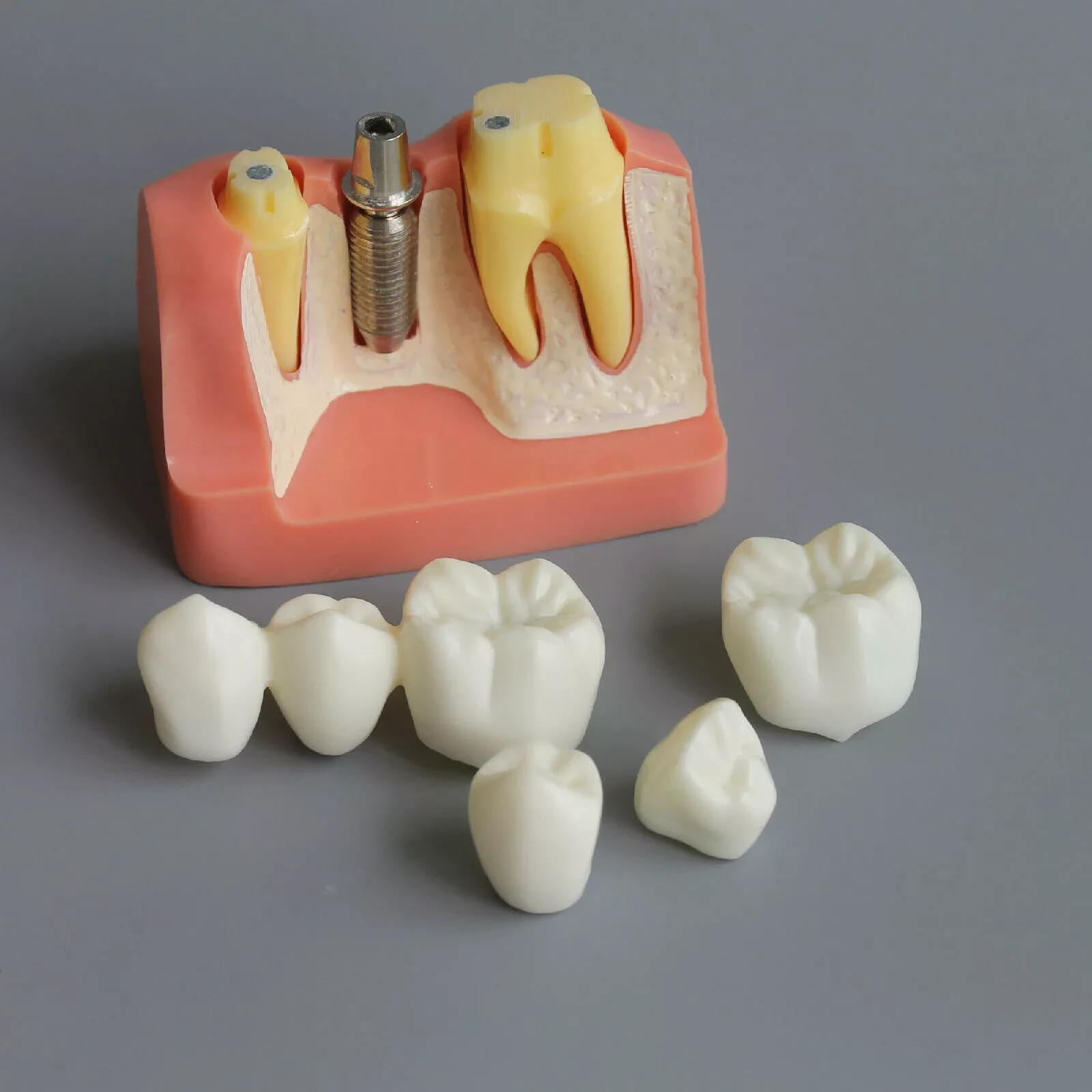 2Pc Dental Oral Analysis Crown Bridge Demonstration Tooth 4 Times Model Typodont