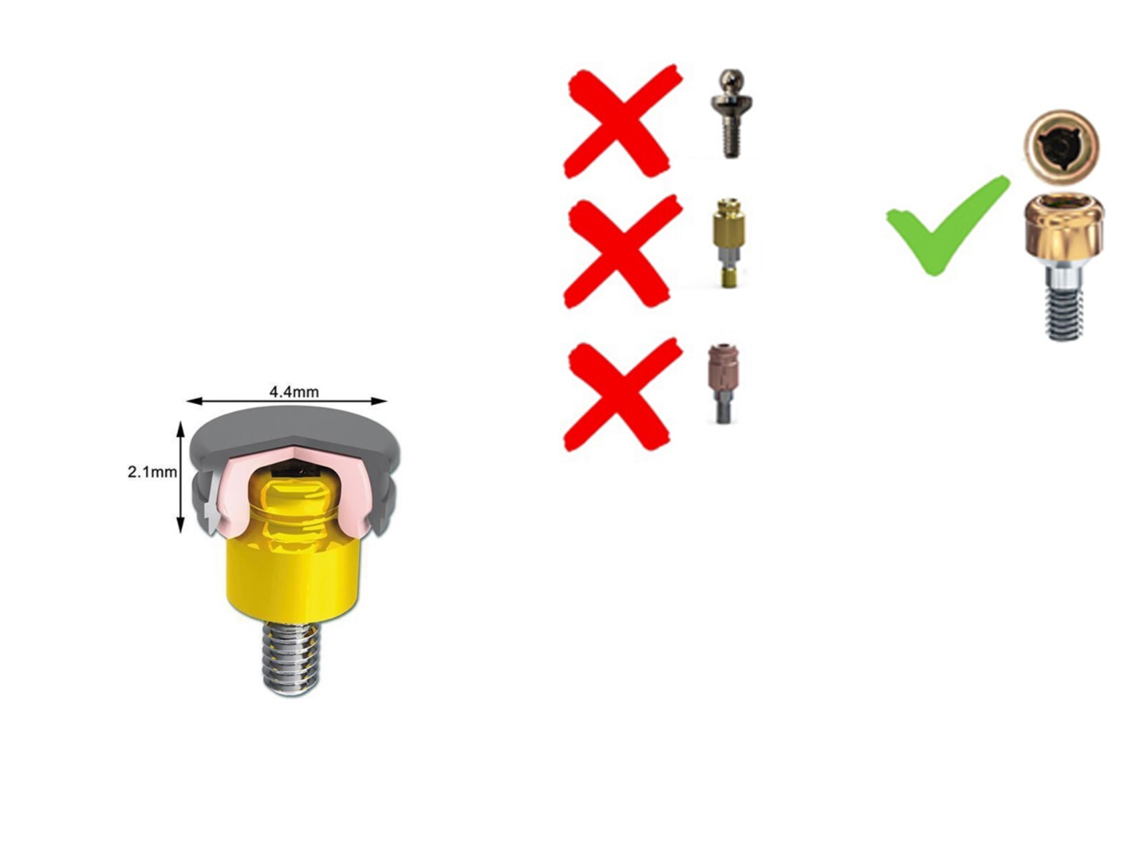 4Pcs US Dental Locator Abutment Retention Caps Metal cap & black Inserts Set